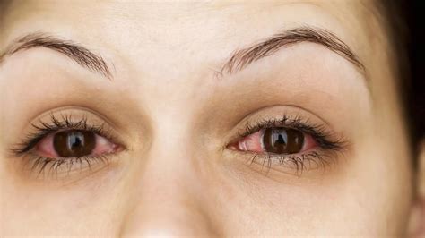 How Long Does Pink Eye Last Intro Symptoms Types And Prevention