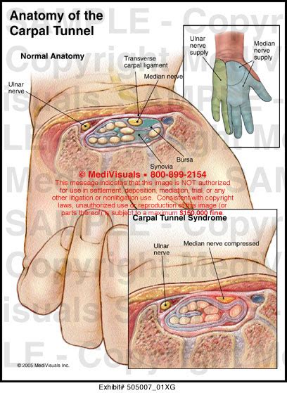 An overview of carpal tunnel syndrome, including aetiology, relevant anatomy, clinical features, investigations, management and prognosis. Anatomy of the Carpal Tunnel Medical Illustration Medivisuals
