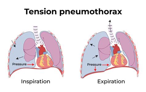 Difference Between Pneumothorax And Tension Pneumothorax Geeksforgeeks