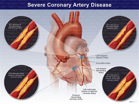 Severe Coronary Artery Disease Trial Exhibits Inc