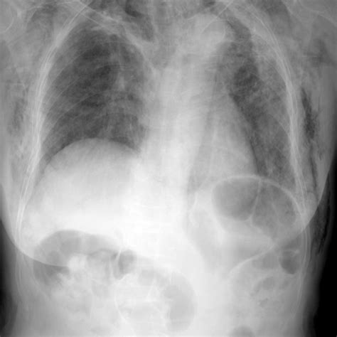 Chest Radiography Demonstrates Mediastinal And Subcutaneous Emphysema