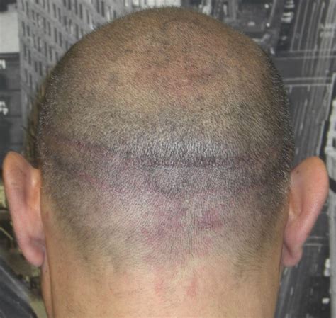 Scar Camouflage With Scalp Micro Pigmentation At Evolve Hair Clinic