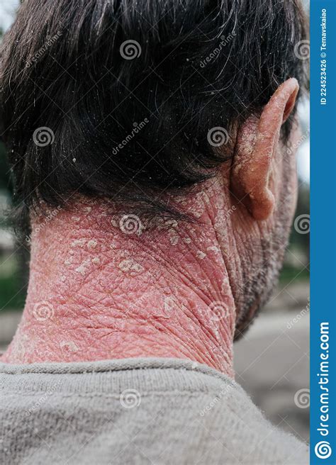 A Man With Psoriasis On His Back And Neck Scratch With His Hand Back