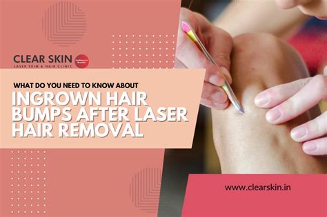 Need To Know About Ingrown Hair Bumps After Laser Hair Removal