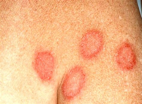 Nummular Eczema Pictures Causes Symptoms Treatment