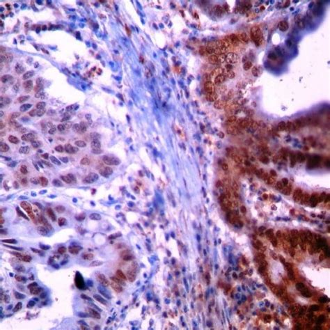 P16 Immunohistochemical Staining In In Normal Uterine Cervical Squamous