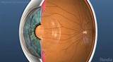 A cataract is a cloudy area in the lens of your eye. Cataract: Everything You Need to Know - Medical Eye Associates