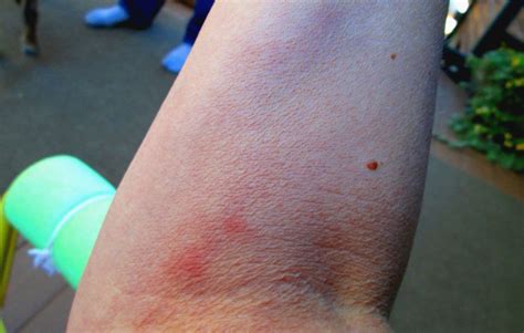 Blood Clot On Skin Symptoms Pictures Symptoms And Pictures