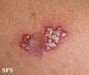 It appears in the form of sores on the mouth or genitals. Herpes Simplex Virus (HSV) Infection, Types, Pictures, Treatment | Healthhype.com