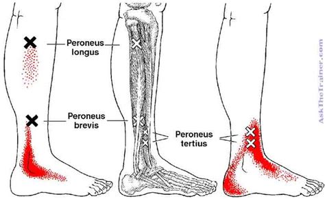 Trigger Points For The Peroneus Longus Trigger Points Peroneus