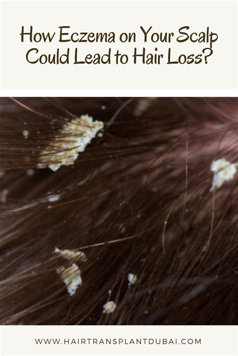 How Eczema On Your Scalp Could Lead To Hair Loss Eczema Hair Loss