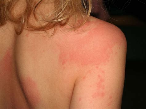 Identify Itchy Skin Rashes My XXX Hot Girl