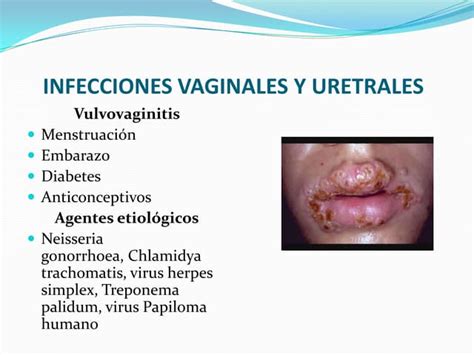 Infecciones Vaginales Y Vph Los Mas Frecuentes En El Mundo
