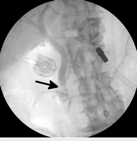 Intraoperative Cholangiogram Prior To Common Bile Duct Exploration