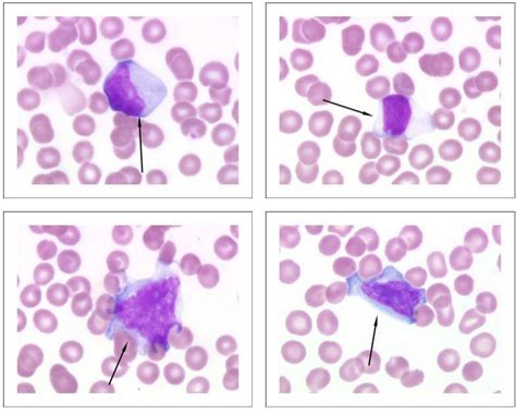 Reactive Lymphocytes Microscopic Cells Medical Lab Technician Lab