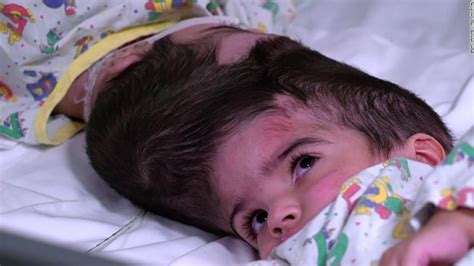 Sisters Conjoined At The Head Are Separated After 50 Hours Of Surgery Cnn