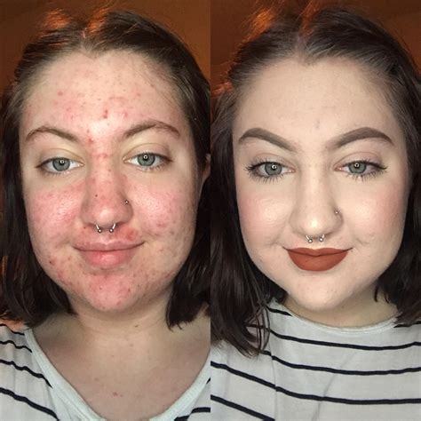 Acne Makeup Before And After Saubhaya Makeup