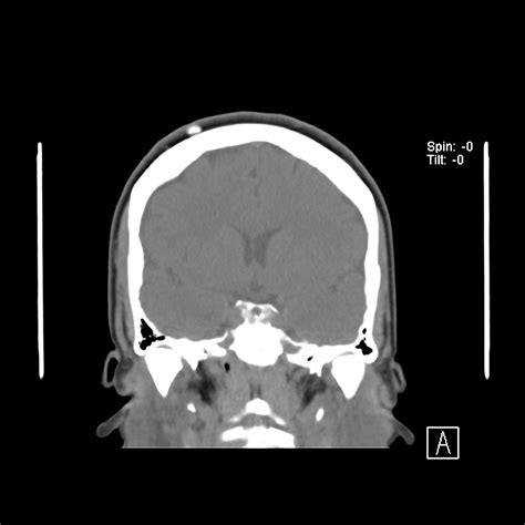 Trichilemmal Cyst Image