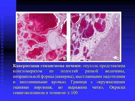 Диета в гемангиома печени
