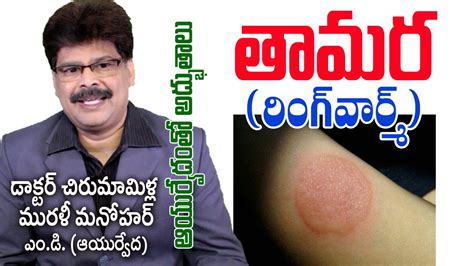 Ringworm Infection Ayurvedic Treatment తామర Prof Dr Murali