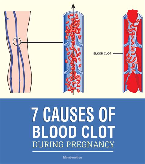 7 Most Common Causes Of Blood Clot During Pregnancy