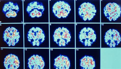 A La Caza De La Huella Oculta Del Alzhéimer Incipiente Ciencia El PaÍs