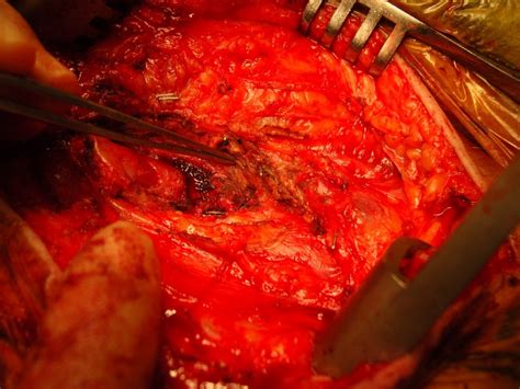 Lump In The Groin After Common Femoral Endarterectomy Technical
