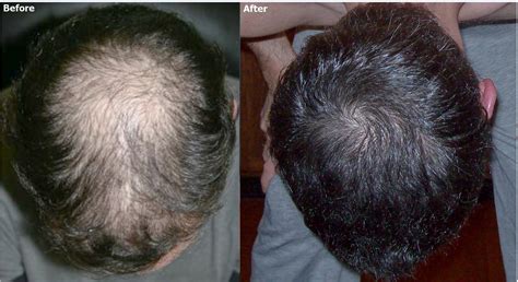 Crown Hair Restoration Alviarmani Hair Transplant Los Angeles