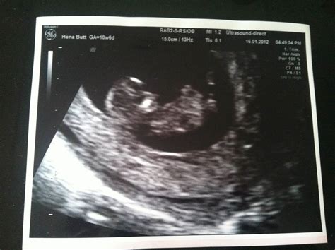 My First Baby Babys First Scan Picture