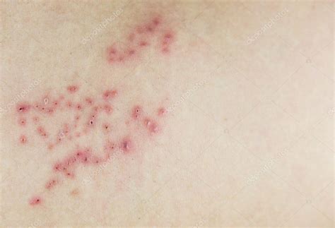 Raised Red Bumps And Blisters On Skin Stock Photo By ©hatchapong 110442532