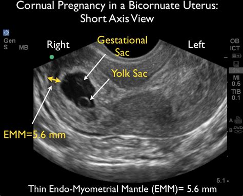 Transvag Ultrasound During Pregnancy Transvaginal Ultrasonography And