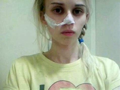 A Young Girls Anorexia Became So Severe She Believed She Could Breath