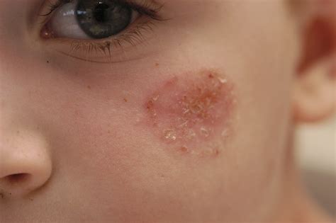 Impetigo What Is It And How It Affects You Sjh Derm