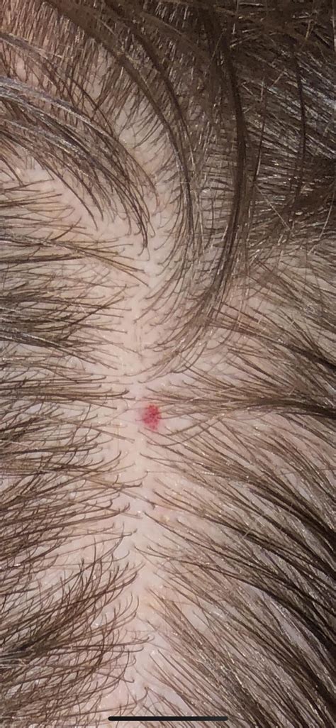 Am I Developing Developing Ringworm On My Scalp I Had Ringworm On My