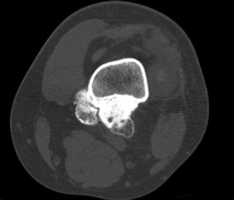 Parosteal Osteosarcoma Image