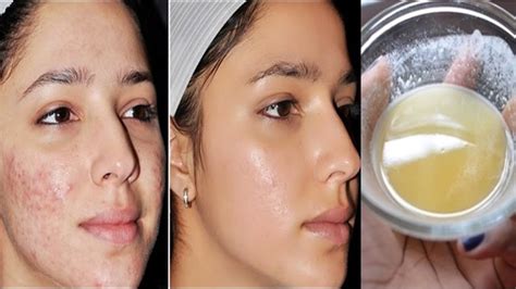 How To Get Rid Of Acne Scars Fast With Baking Soda Powerful Home