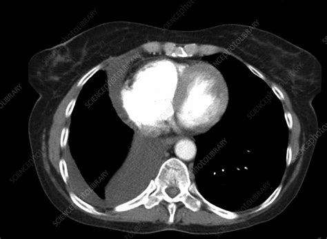 Pleural Effusion Ct Scan Stock Image C0366430 Science Photo Library