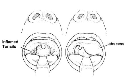 Peritonsillar Abscess Symptoms Pictures Drainage And Treatment