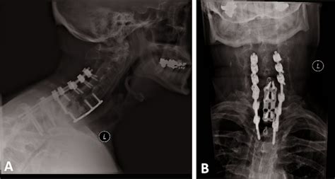 Cureus Surgical Stabilization Of A Cervical Fracture In A Patient