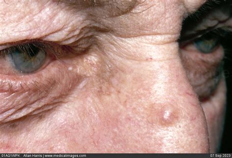 Basal Skin Cancer Face