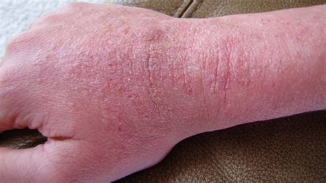 Skin Rash Pictures Causes Types And Treatments