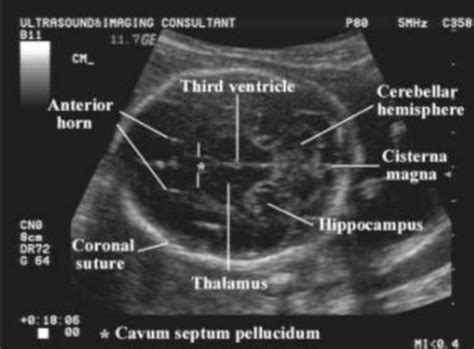 Sonography Of Second And Third Trimester W Fetal Growth Assessment