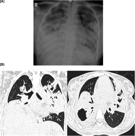 A Cxr Showed Bilateral Patchy Consolidation B Ct Chest Images