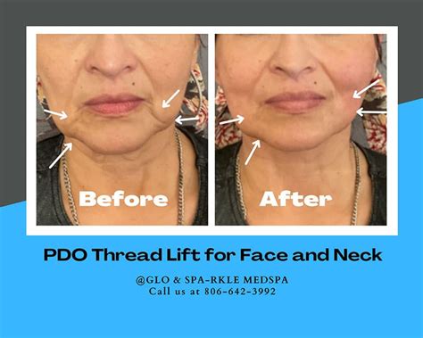 Before And After Pdo Thread Lift Procedures In Lubbock Glo And Sparkle