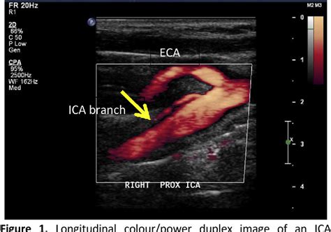Detection Of Anomalous Cervical Internal Carotid Artery Branches By