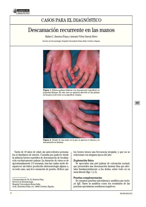 S0213925103727269 Dermatitis Exfoliativa De Manos Y Su Tratamiento