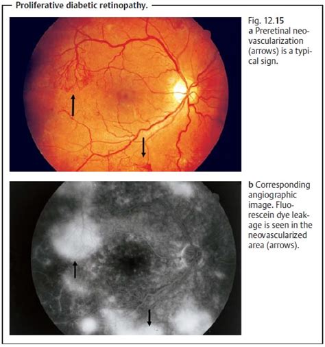 Diabetic Retinopathy