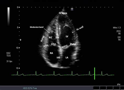 How To Do Echocardiography Standard Protocol For Performing