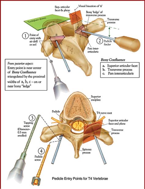 Figure From Accuracy Of Free Hand Pedicle Screws In The Thoracic And Lumbar Spine Analysis Of