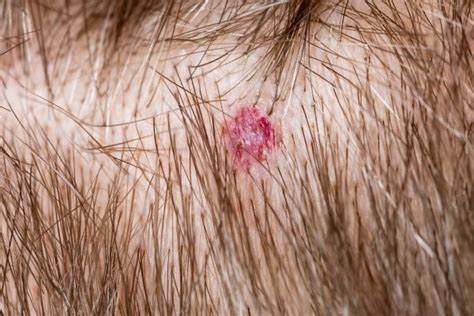 How To Treat Bacterial Scalp Infections And Prevent Hair Loss Phs